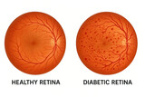 Comparison of a healthy retina and a diabetic retina, illustrating the visual impact of diabetes on the eye.