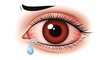 © Kembar - Detailed illustration of a red irritated eye with a tear isolated