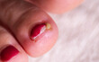 © HENADZY - Healthy nail care tips for preventing ingrown toenails and promoting foot health