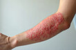 © miss irine - Person shows severe red skin rash, allergic reaction. Contact dermatitis disease appears on forearm skin. Many red bumps, irritation, inflammation, eczema cover arm. Itchy skin condition health