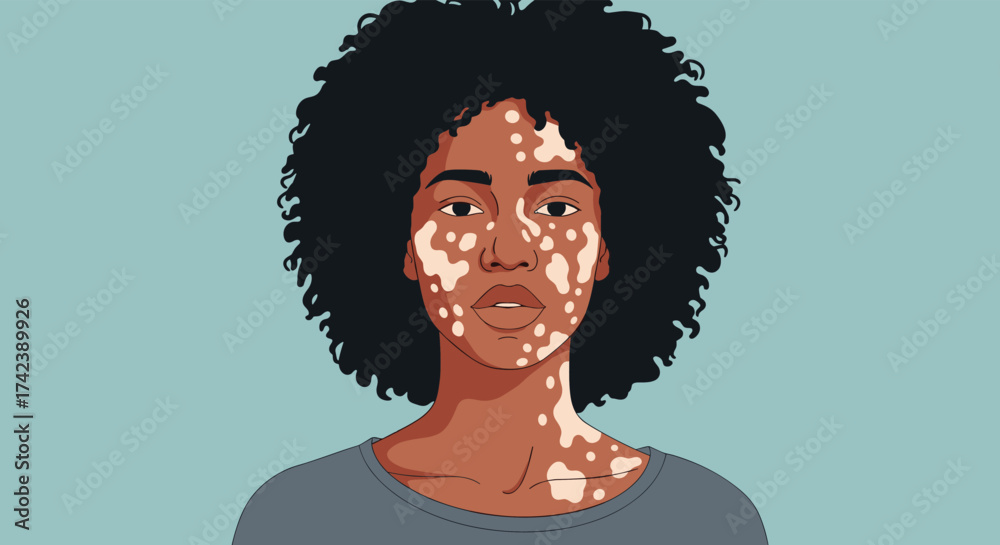 Understanding the causes and effects of vitiligo on skin health and ...