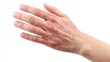 © Newleks - Hand with severe dermatitis, eczema, or allergic skin reaction, showing red, itchy, inflamed bumps and rash, indicating irritation, infection, or skin condition
