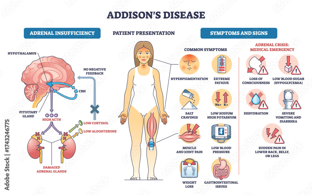 Addisons disease outline illustrates adrenal insufficiency, HPA axis ...