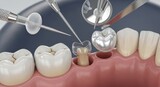 Dentist performing dental filling procedure on tooth root canal treatment close-up macro view