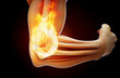 © Julien Tromeur - Conceptual 3D illustration of a tennis elbow on fire