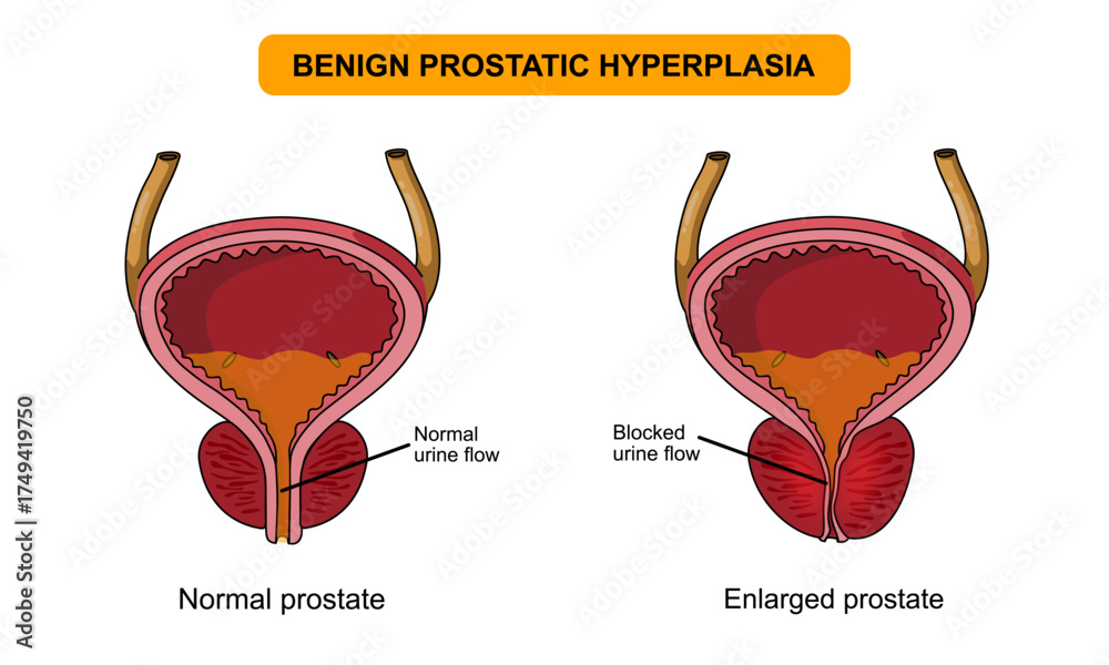 Bph Bladder Illustration of benign prostatic hyperplasia. Normal bladder and BPH ...