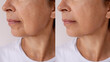 © Марина Демешко - Before and after close-up of a mature woman’s lower face and jawline, showing visible skin improvement, reduced wrinkles and smoother texture. Anti-aging or skincare concept. Facelift, plastic surgery