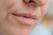 © Sk Elena - Macro of female lips with visible cold sore. Herpes infection during illness and cold. Concept of self care, treatment, and health protection.