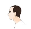 © moonlightfever - Receding hairline  alopecia on man character , baldness, norwood