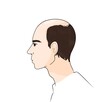 © moonlightfever - Balding hairline  alopecia on man character,  baldness, norwood