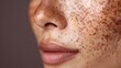 © LimeSky - Dark marks blemishes excess pigmentation melasma or chloasma skin whitening concepts