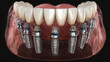© Thiago - Dental implants showcase in a dental model, highlighting the structure and position of these replacements. The image emphasizes the aesthetics and functionality of the implants.