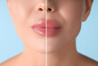 © New Africa - Female lips before and after augmentation procedure, closeup. Photo divided into halves