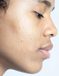 © rafaelcampezato - close-up photograph of the pimples and blemishes on a skin