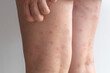 © Evgeniia Primavera - Close-up of a person s legs covered with red itchy spots, scratching the skin, showing an allergic reaction or insect bites, symbolizing discomfort, irritation, and dermatological health problem