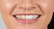 © Imam - Before and after cosmetic teeth whitening. Split face comparison showing dental transformation and brighter smile.