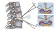 © JIBON - Surgical procedure illustrating spinal cord decompression and disc herniation repair illustration