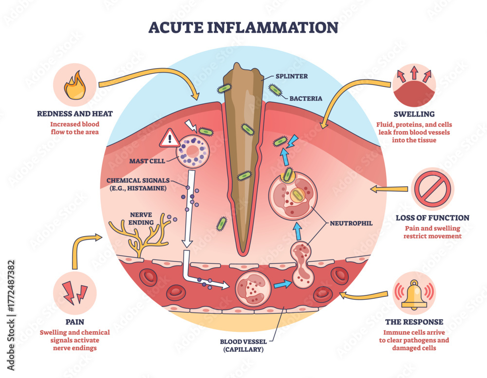 Acute inflammation overview, skin injury with splinter, neutrophils in ...