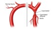 © Ayesha - Comparative view of normal artery versus artery with stenosis and aneurysm illustration