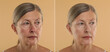 © New Africa - Woman before and after anti-aging treatment on beige background, closeup. Collage showing skin rejuvenation