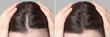 © New Africa - Woman with hair loss problem before and after therapy, closeup. Collage on grey background