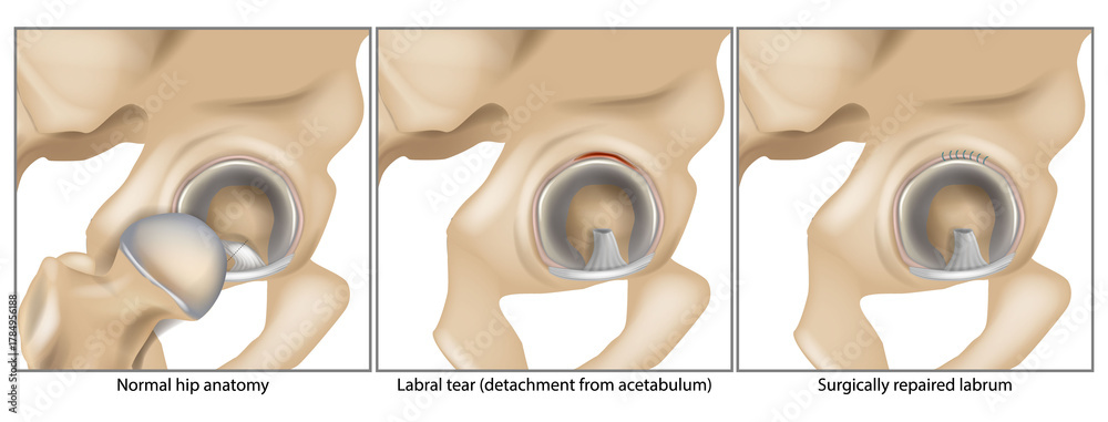 Detailed medical illustration showing the stages of hip labral injury ...
