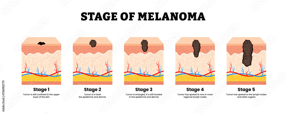Stages of melanoma stage. The TNM classification of malignant tumors ...