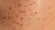 © Agus - Detailed close-up of fair human skin displaying numerous small brown pigmentation marks, indicative of freckles or sunspots, showcasing natural skin texture and dermatological features