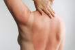 © Ilona - Back sunburn with hand on shoulder, red skin and itching, close-up of upper back photo