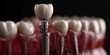 © Rifqi - Close-up of dental implant in the jawbone with row of teeth in the background, concept for tooth restoration, dental hygiene and medical treatment
