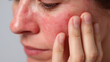 © Marut - Closeup of irritated sensitive skin with visible redness, inflamed cheek, and dry texture, showing discomfort and possible allergic reaction or skin condition