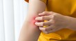 © isolatedpng - Irritated skin on arm, a woman scratching her red and itchy skin due to allergies or mosquito bites, dermatological skin problem, inflammation