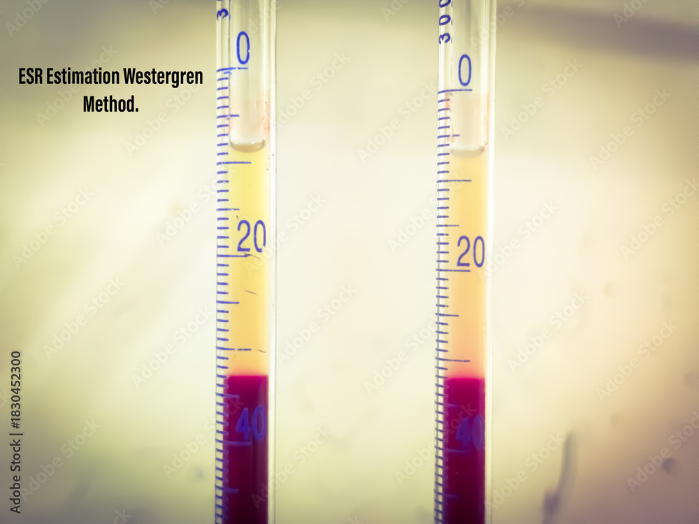 Westergren Lab Westergren method is a standardized test for measuring the erythrocyte ...