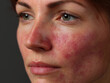© Thanakorn - Mild atopic dermatitis visible on woman face, showing red and irritated skin. close up highlights texture and condition of skin, conveying sense of vulnerability