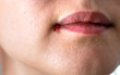 © yanadjan - Herpes in women on the lip. Selective focus.