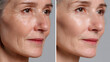 © john - Before After anti aging face photo skin spa treatment older woman 40s 50s menopause wrinkles fine line saggy jowls afterwards smooth glowing younger firm microneedling rf therapy LED laser treatment