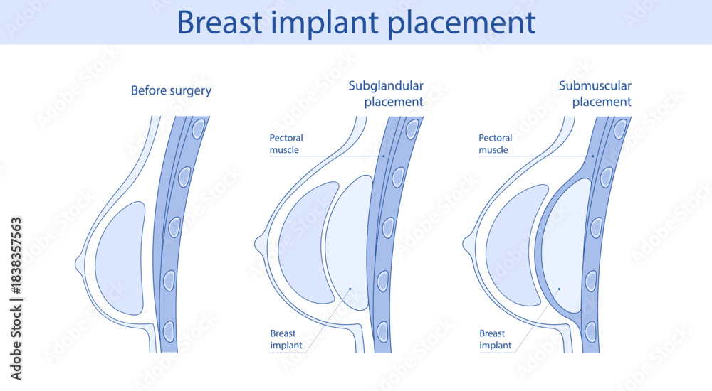 Breast implant placement diagram. Subglandular and submuscular types of
