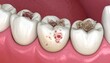 © FACTORY GRAPHICA  - An up-close shot of damaged teeth, revealing cavities and signs of decay, which highlights the importance of dental care.