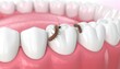© FACTORY GRAPHICA  - A detailed dental close-up showcasing the reality of oral hygiene challenges with an illustration of bacteria, highlights the critical importance of a proactive approach to dental health.