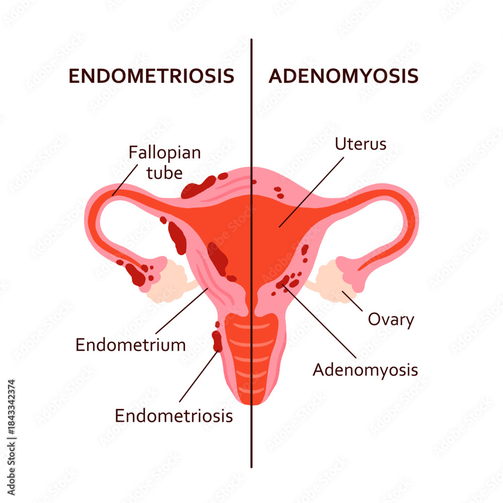 Endometriosis Vs Adenomyosis Comparison Diagram Split Uterus Vector Endometriosis Vs Adenomyosis Comparison Diagram Split Uterus Vector