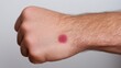 © pornthip - Close-up of a distinct red and purple bruise on the fair skin of a persons hand and lower forearm, suggesting a minor injury.