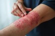 © Viktor - Arm skin with rash. Human with dermatitis on body. Allergic skin reaction close up. Healthcare background with ill psoriasis eczema texture. Infected painful skin needs dermatology treatment and care.