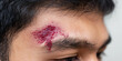 © Bonsales - Man suffering painful forehead injury, a fresh bloody wound with damaged skin and visible blood