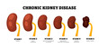 © vesvocrea - Stages of chronic kidney disease stages. From normal, mildly, moderate to kidney failure. Mildly decreased, to Kidney failure. Renal dysfunction. GFR test result. Flat vector illustration.