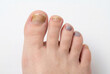 © DebbyMelindaYanti - Close-up of a human foot showing various unhealthy toenail conditions: fungal infection on the big toe and subungual hematomas (bruising) on other toes