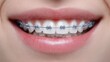 © sablengjago - Close-up of a smiling mouth with orthodontic braces, showing straight, white teeth and pink lips. The skin around the mouth appears smooth