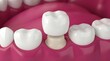 © ye - Close-up of dental crown restoration on healthy tooth with pink gums, dental care and oral health concept