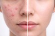 © Alamin - Before and after comparison of skin with acne and clear skin after successful treatment