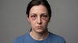 © Volha - Woman with facial injuries after abuse in studio