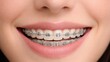 © ภัทรดนัย บุญชูเดชะ - Close-up of a smiling mouth with metal braces, showing straight white teeth and natural lips, representing orthodontic treatment and dental care.